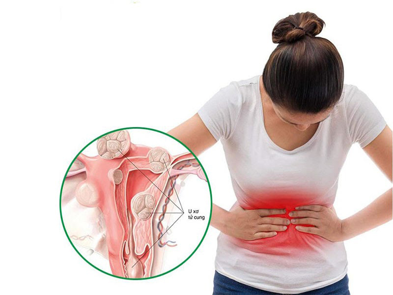 U xơ tử cung gây ra các cơn đau tức vùng bụng dưới kèm theo triệu chứng rối loạn chu kỳ kinh nguyệt